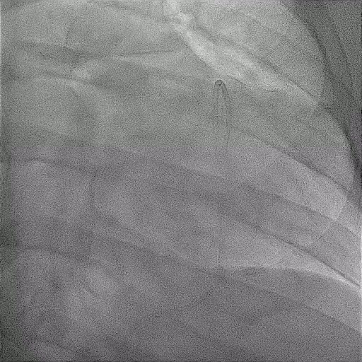 Fluoroscopic image of a pericardial effusion being drained during pericardiocentesis