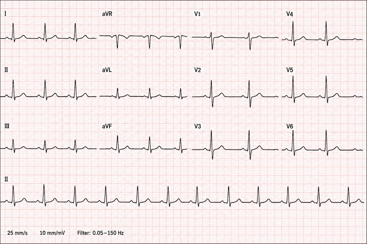 A normal 12-lead electrocardiogram tracing recorded at 25 mm/s and 10 mm/mV